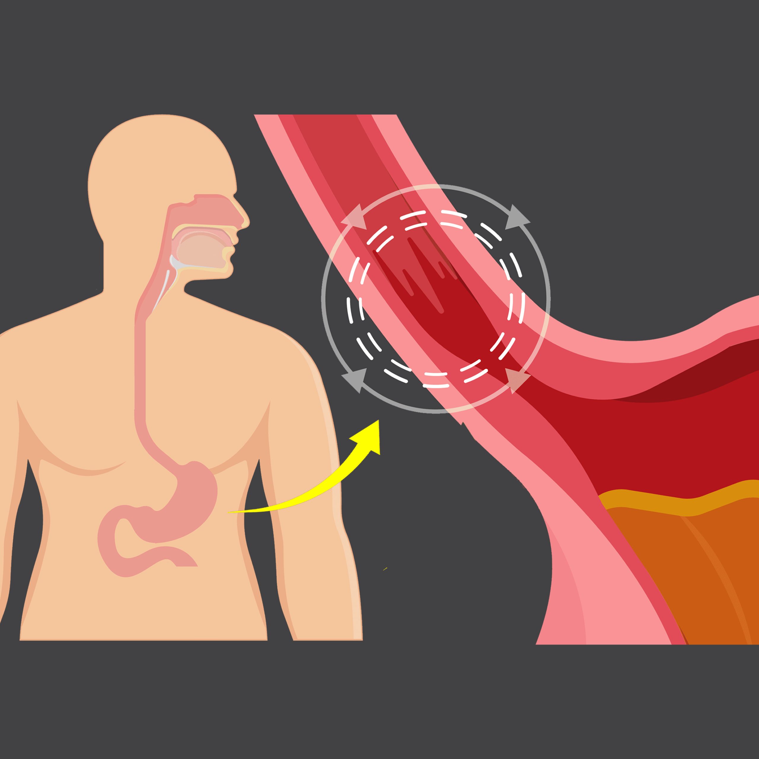 بیماری Barrett’s Esophagus